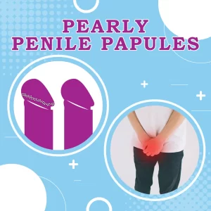 Pearly Penile Papules: White Beads on Penis